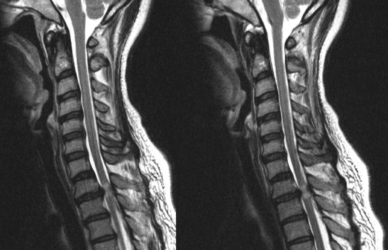 Herniated Disc Thoracic Mri